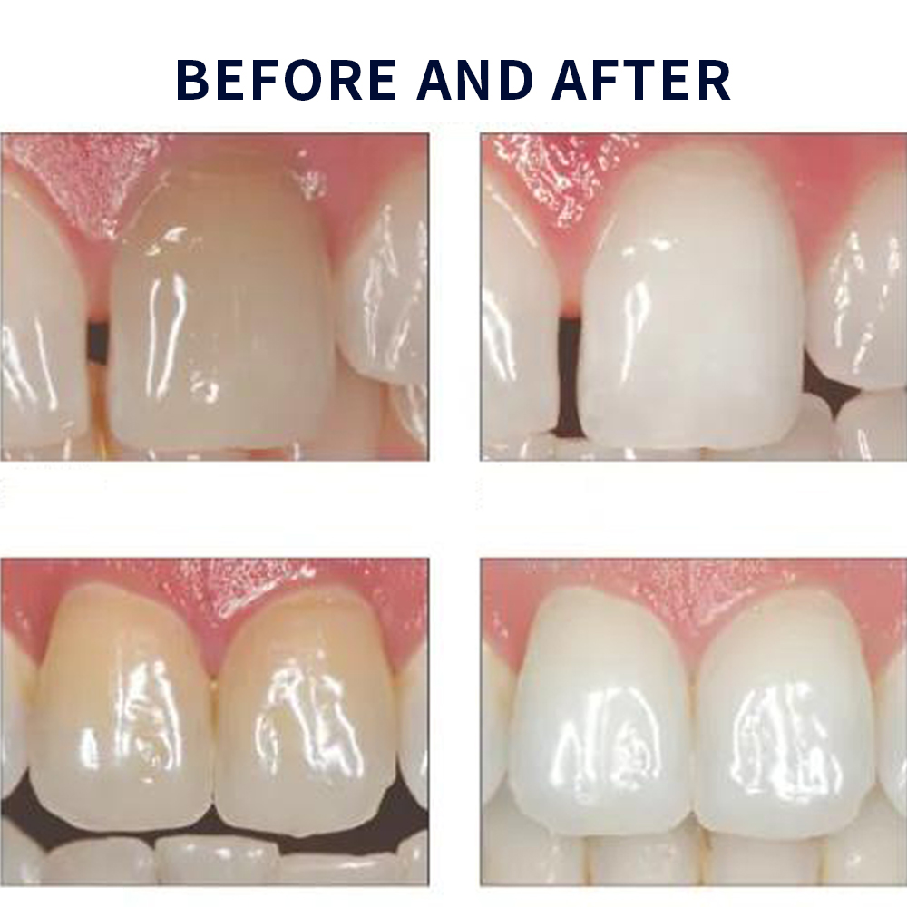 Opalescence Whitening 20% PF 2 - Teeth Whitening Kit At Home ulasan dan harga