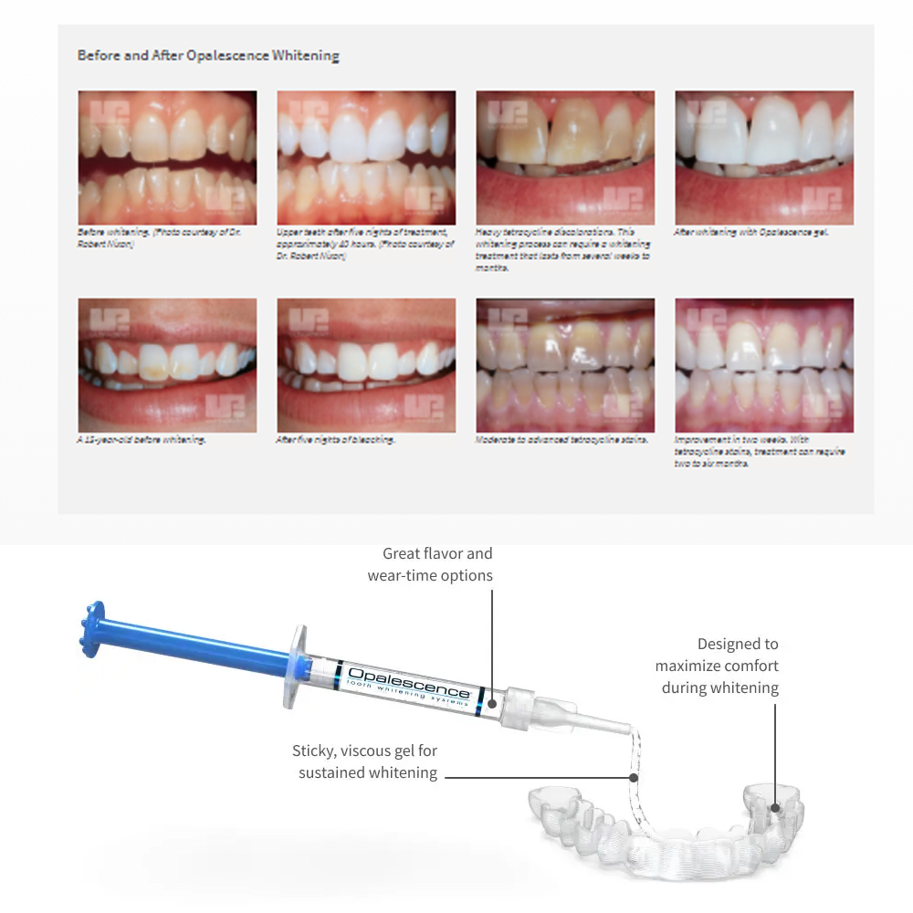 Opalescence Whitening 20% PF 2 - Teeth Whitening Kit At Home ulasan dan harga