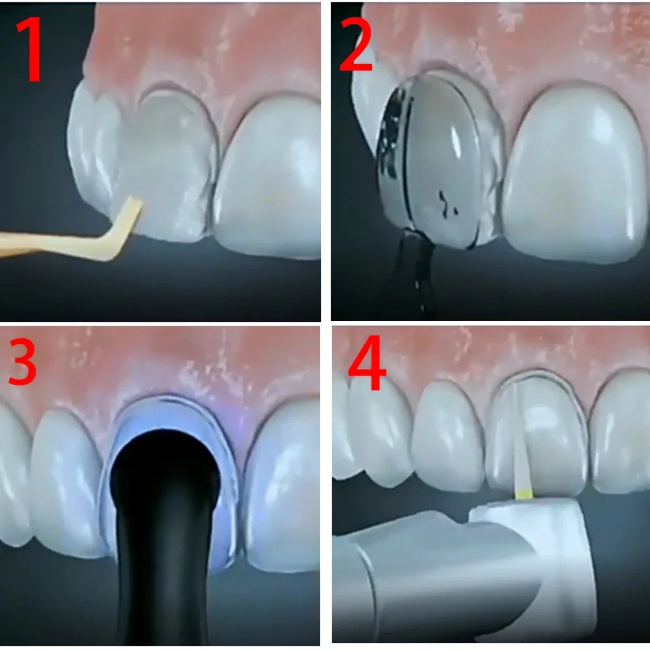 2Set Kit Cetakan Laboratorium  - Teeth Whitening Moulds ulasan dan harga