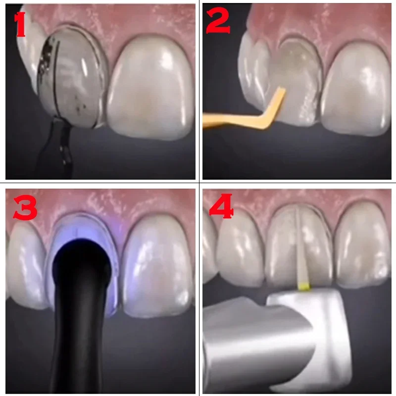 Cetakan Gigi untuk Veneer Resi - Teeth Whitening Moulds ulasan dan harga