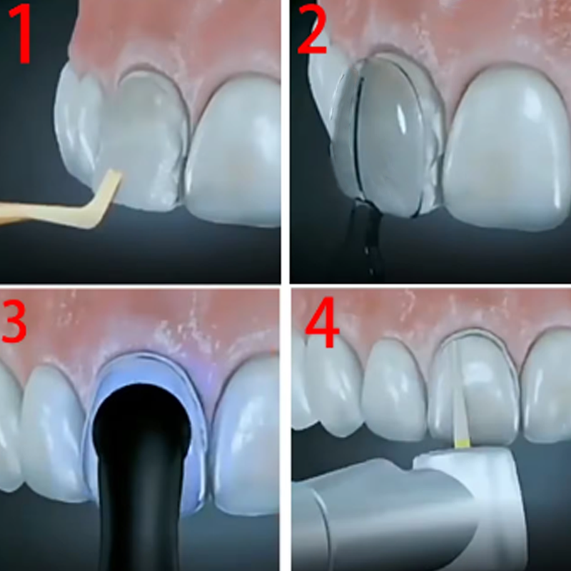 32 buah/kotak Kit cetakan lapi - Teeth Whitening Moulds ulasan dan harga